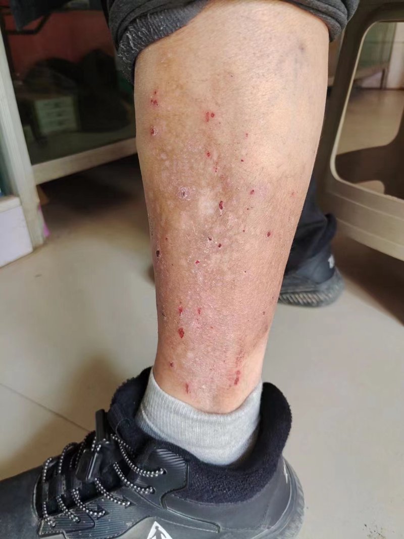 渭南皮肤病医院:为健康保驾护航