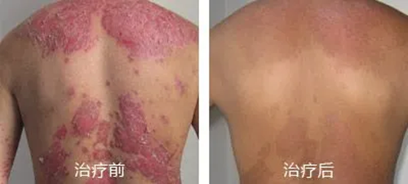 白癜风治疗趋势与对策